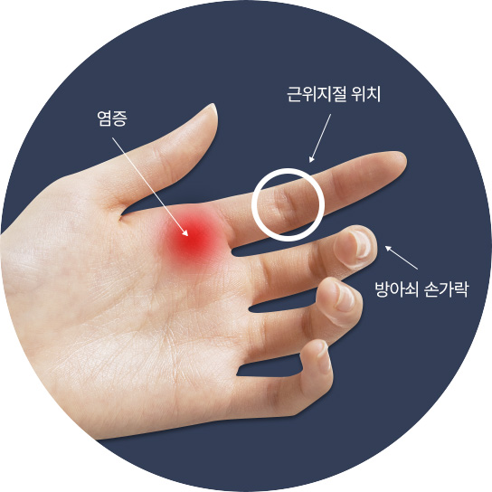 염증 / 근위지절 위치 / 방아쇠 손가락