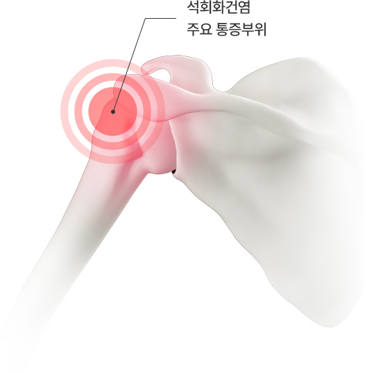 석회화건염 주요 통증부위
