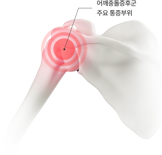 어깨충돌증후군 주요 통증부위