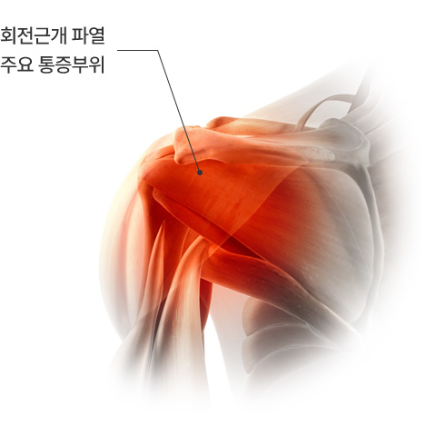 회전근개 파열 주요 통증부위