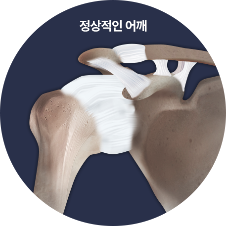 정상적인 어깨