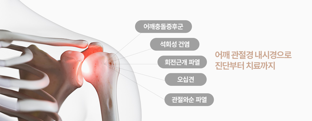어깨충돌증후군, 석회성 건염, 회전근개 파열, 오십견, 관절와순 파열 : 어깨 관절경 내시경으로 진단부터 치료까지